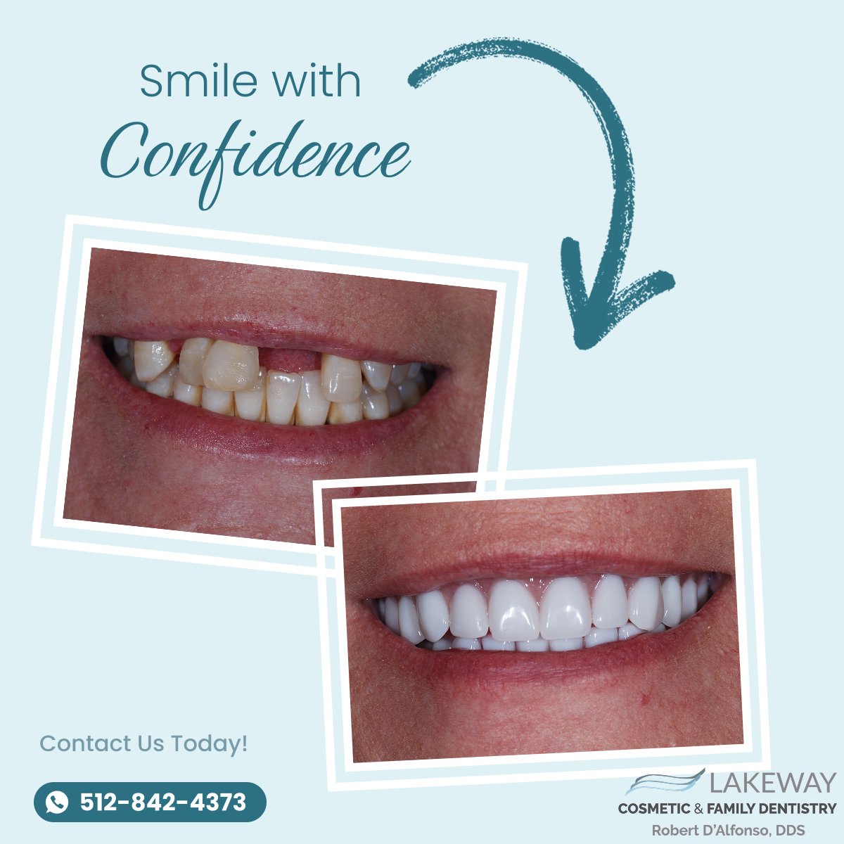 Lakeway Cosmetic & Family Dentistry — Facebook Ad Design Veneers and dental implants before-and-after Facebook ad design example